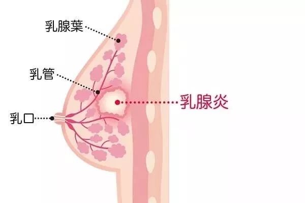 乳房硬得像石頭，碰一下要親命！分分鐘讓人想斷奶的乳腺炎，該怎麼辦? 親子 第4張