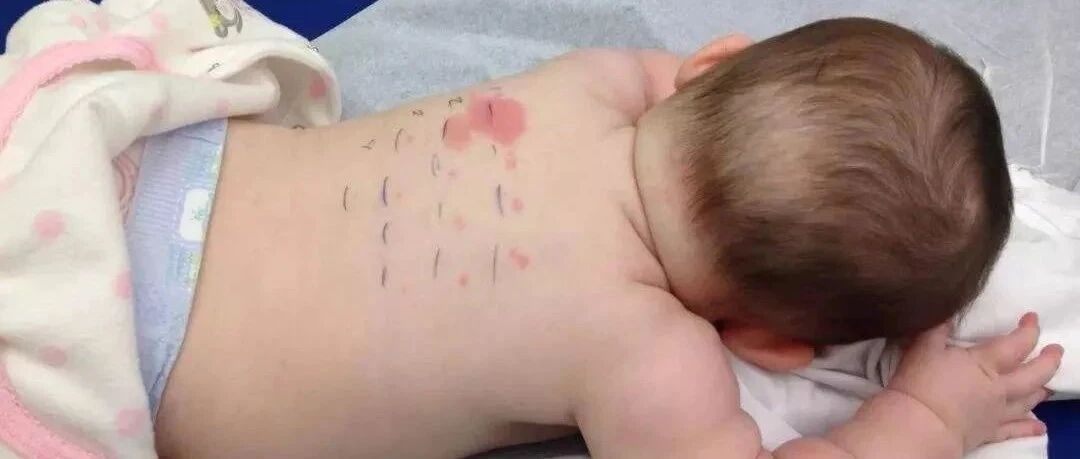 有必要给孩子做个过敏原检测吗？