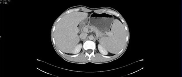 30岁以后，求求你关注下肝癌