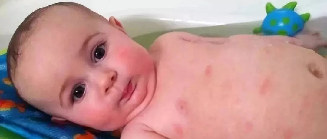 孩子鱼虾蛋奶都过敏，这还咋补营养？