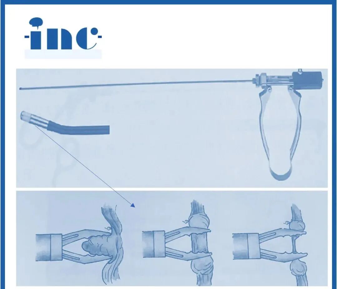 双极电凝为什么要冲水神外科普系列｜2分钟动画解读：什么是双极电凝？有什么作用？_https://www.jmylbn.com_新闻资讯_第2张