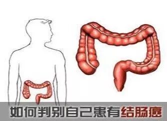 fh染色是什么意思直肠癌筛查——FH检测技术_https://www.jmylbn.com_新闻资讯_第3张