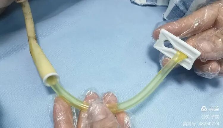 引流袋管子怎么不流病痛一“管”到底—“T管”的居家护理_https://www.jmylbn.com_新闻资讯_第6张
