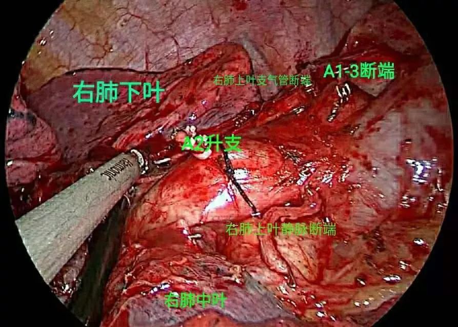 史上最全的右肺上叶肺段相关解剖（一）：动脉