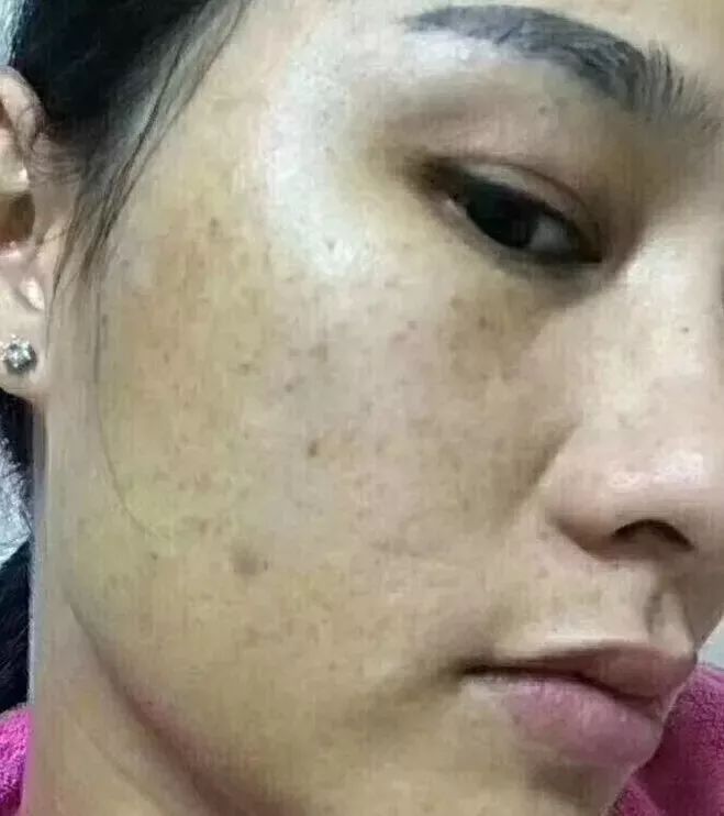 使用前：肤色暗沉，伴有斑点、痘印，以及黑色素沉淀。肤色暗黄，看上去
