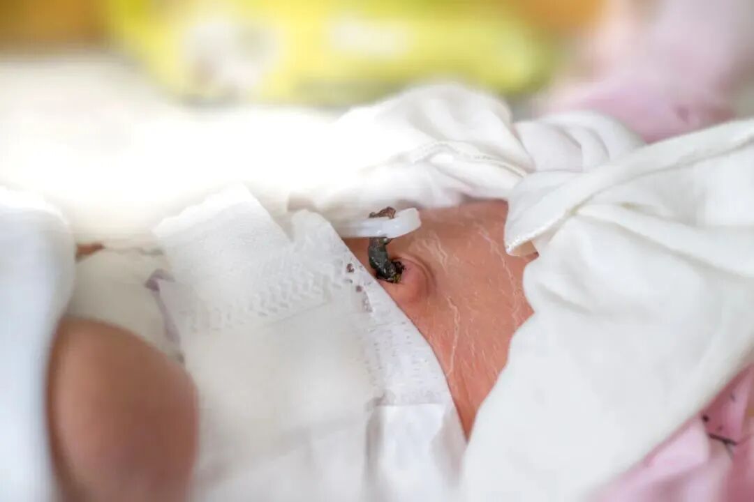 新生儿肚脐夹怎么打开新生儿宝宝的脐带什么时候脱落？肚脐的日常消毒怎么做？_https://www.jmylbn.com_新闻资讯_第1张