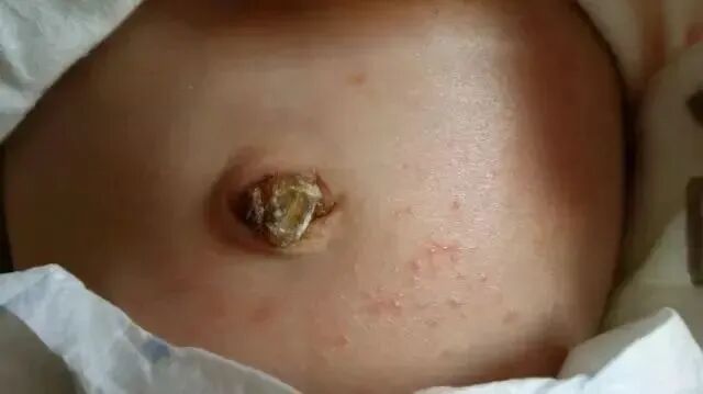 新生儿肚脐夹怎么打开新生儿宝宝的脐带什么时候脱落？肚脐的日常消毒怎么做？_https://www.jmylbn.com_新闻资讯_第22张