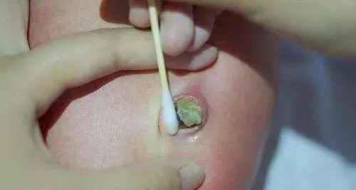 新生儿肚脐夹怎么打开新生儿宝宝的脐带什么时候脱落？肚脐的日常消毒怎么做？_https://www.jmylbn.com_新闻资讯_第19张