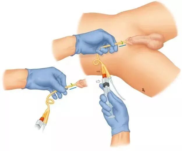 导尿袋有哪些型号护士请收藏！关于导尿，这些问题你都掌握了吗？_https://www.jmylbn.com_新闻资讯_第1张