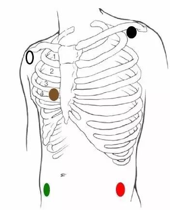 心电监测仪怎么看心电监护仪的操作注意事项_https://www.jmylbn.com_新闻资讯_第4张