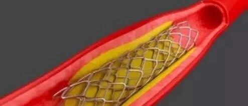 支架滥装、暴利、被淘汰？6分钟视频破解谣言！