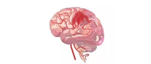 关于“夺命杀手”脑卒中，这10个“误区”很多人都不知道......