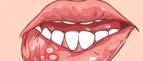 口腔溃疡没完没了？夏季防治有妙招