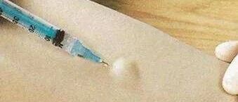 什么药要做皮试，皮试要求知多少......