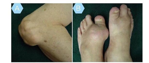 为什么现在这么多人得痛风？6个原因中，一半和吃有关！