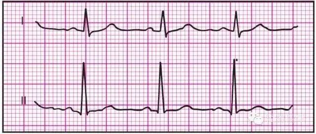 最全面的异常心电参考图，建议收藏!