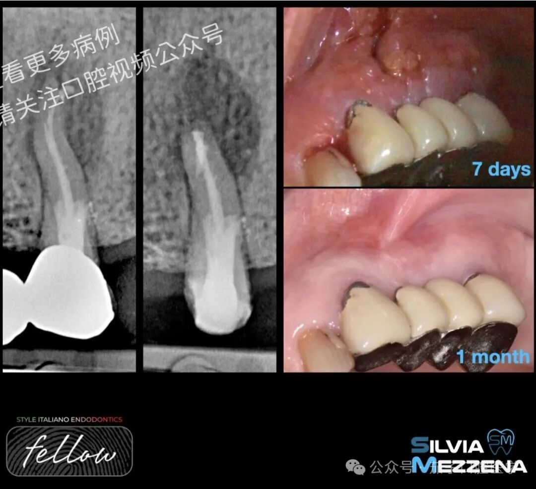 双膦酸盐患者根尖脓肿，保守治疗策略