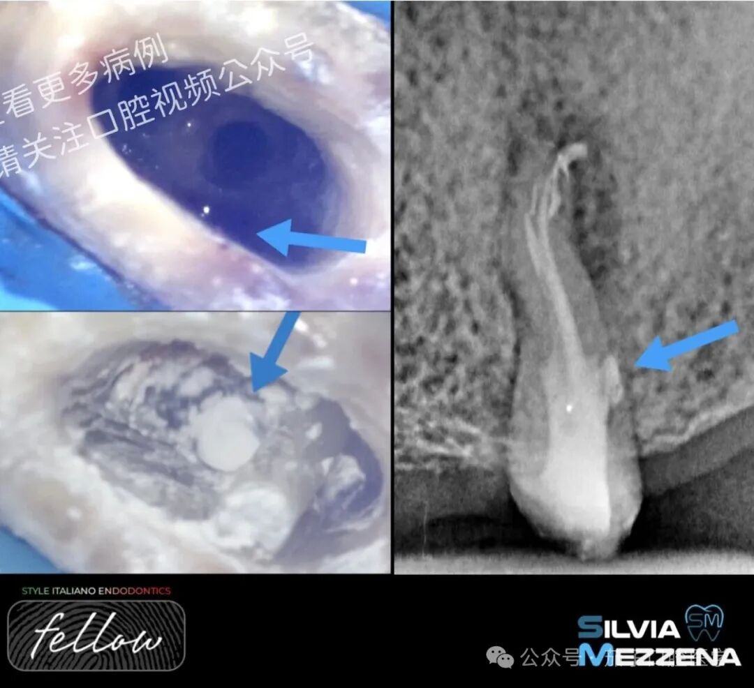 双膦酸盐患者根尖脓肿，保守治疗策略