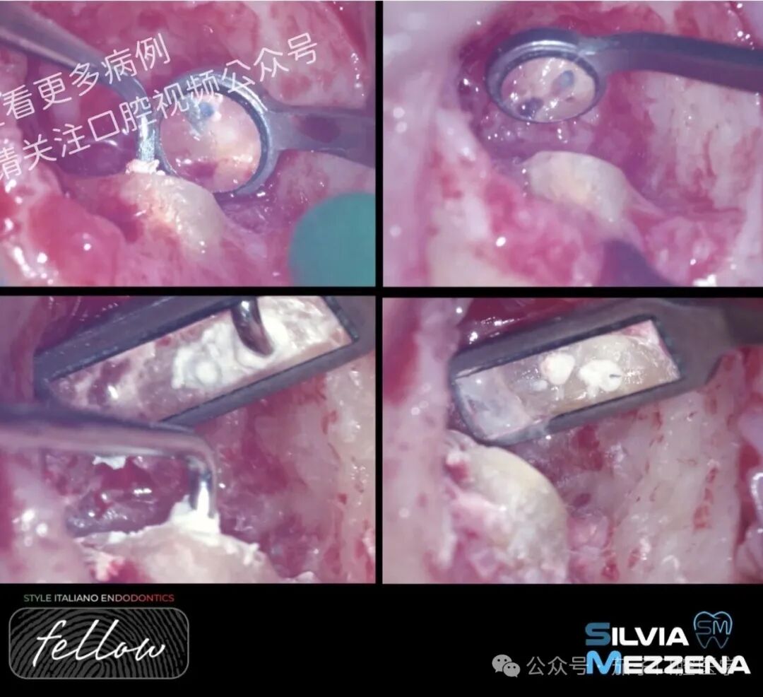 双膦酸盐患者根尖脓肿，保守治疗策略