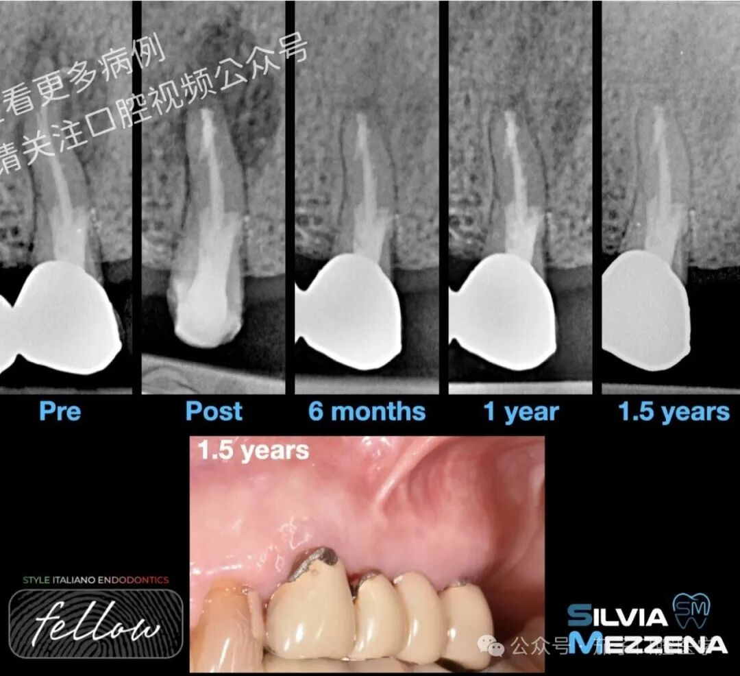 双膦酸盐患者根尖脓肿，保守治疗策略