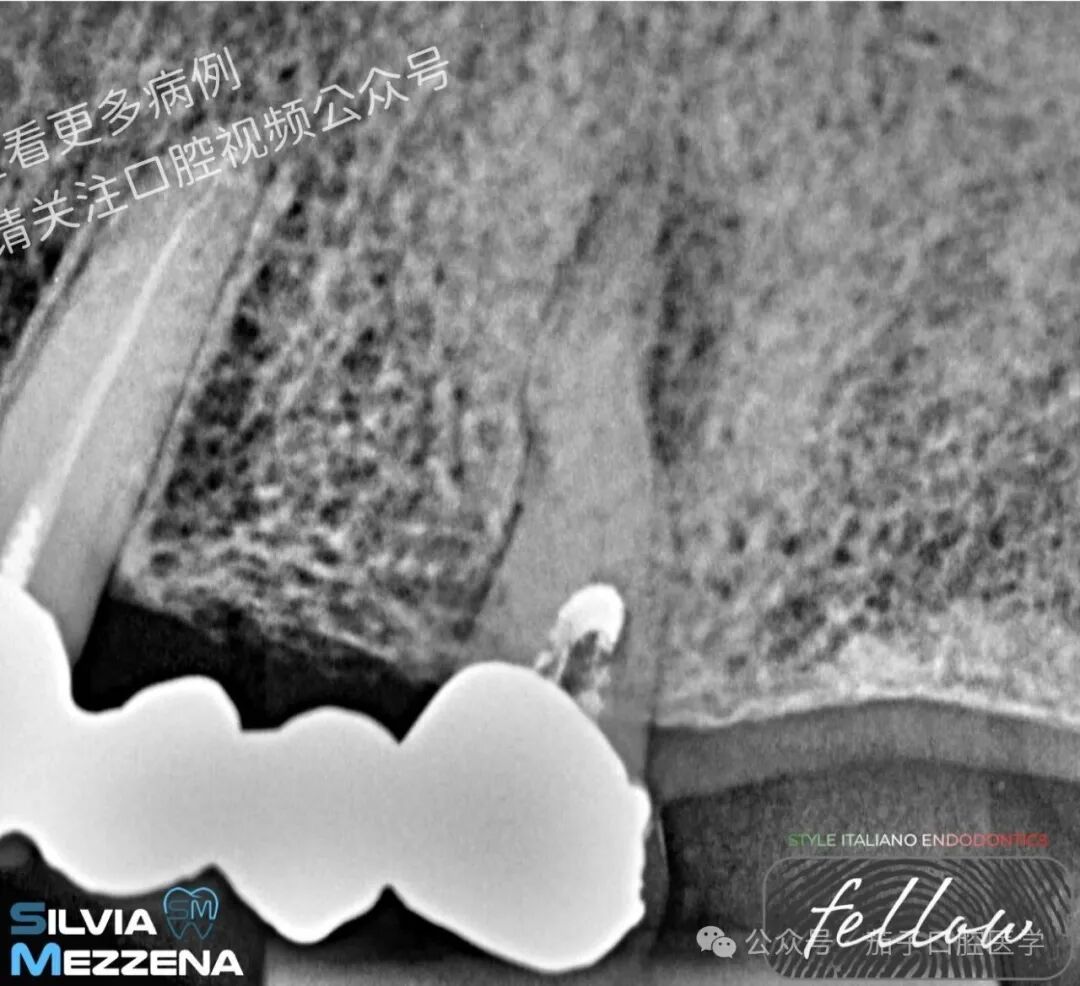 双膦酸盐患者根尖脓肿，保守治疗策略