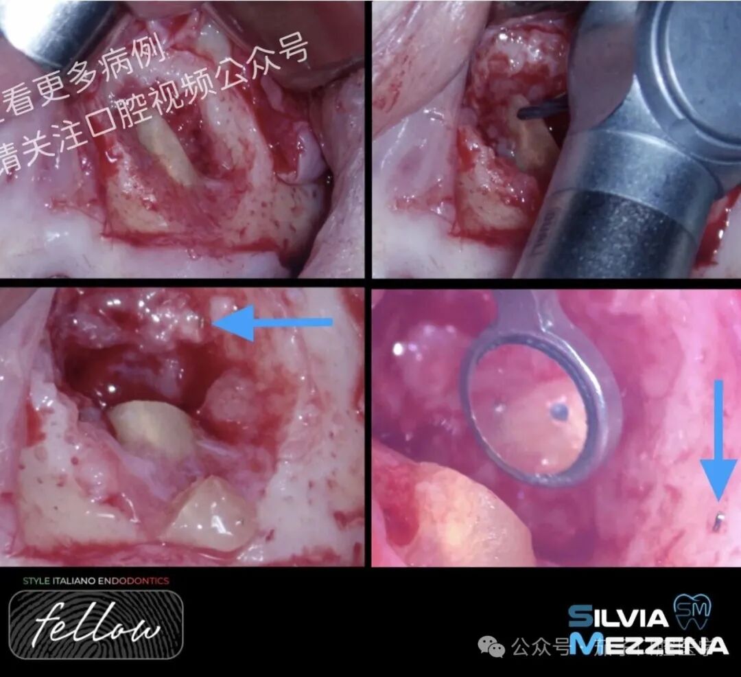 双膦酸盐患者根尖脓肿，保守治疗策略
