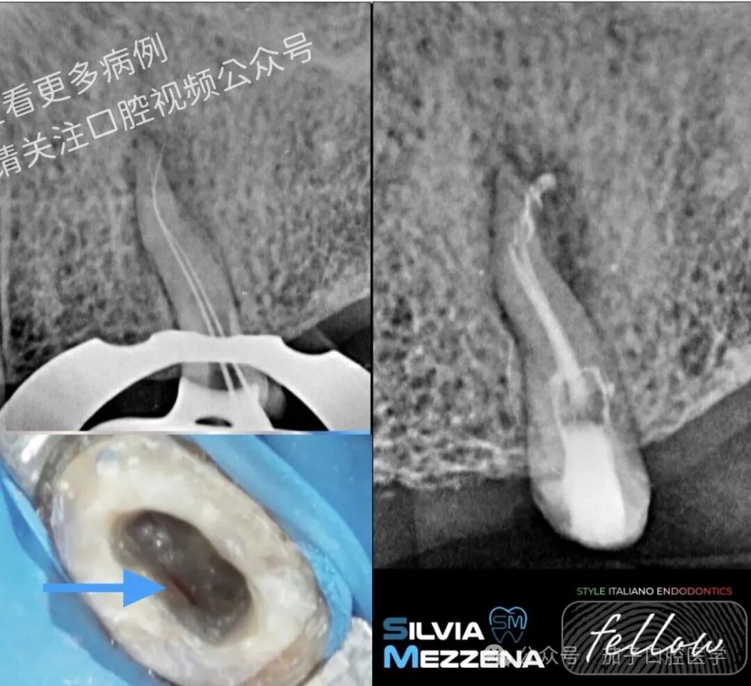 双膦酸盐患者根尖脓肿，保守治疗策略