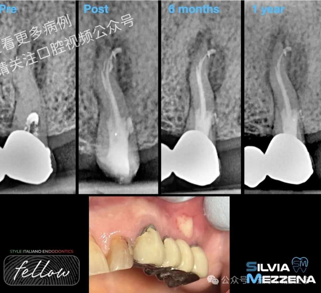 双膦酸盐患者根尖脓肿，保守治疗策略