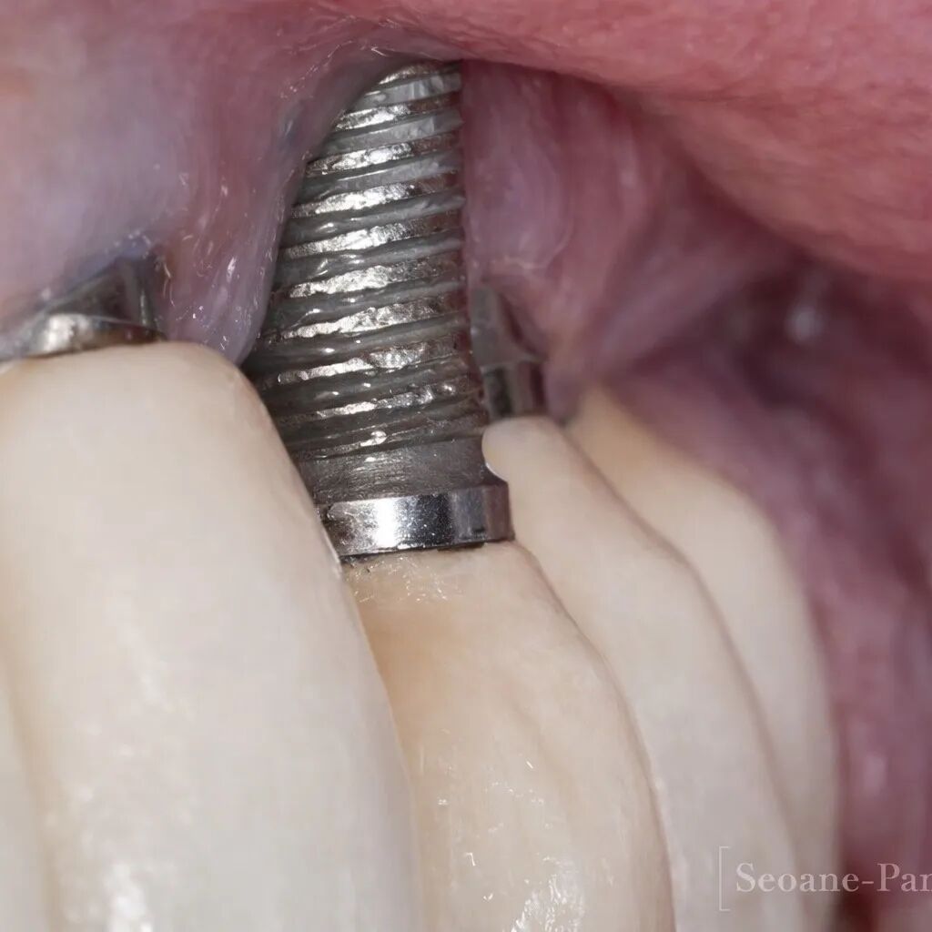 种植体周围炎的药物治疗管理