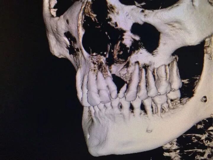 口腔ct怎么看看牙为什么要进行口腔CT检查？不想花这笔钱？_https://www.jmylbn.com_新闻资讯_第16张