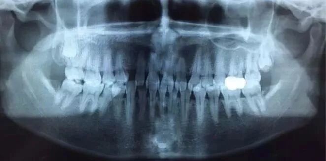 口腔ct怎么看看牙为什么要进行口腔CT检查？不想花这笔钱？_https://www.jmylbn.com_新闻资讯_第12张
