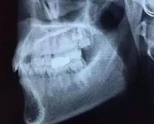 口腔ct怎么看看牙为什么要进行口腔CT检查？不想花这笔钱？_https://www.jmylbn.com_新闻资讯_第7张