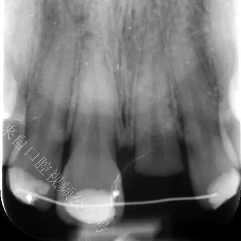 看一例比较疯狂的修复
