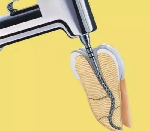 口腔H锉怎么消毒根管治疗中锉的选择，以及使用心得及技巧_https://www.jmylbn.com_新闻资讯_第12张