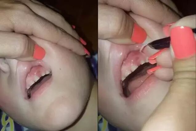 牙龈里拔出27片断甲，是一种怎样的体验？