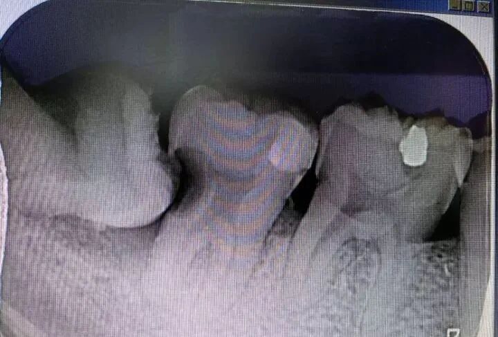 牛牙症的根管治疗步骤及案例