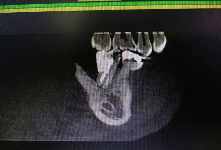 牛牙症的根管治疗步骤及案例
