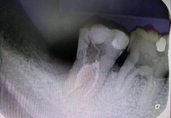 牛牙症的根管治疗步骤及案例