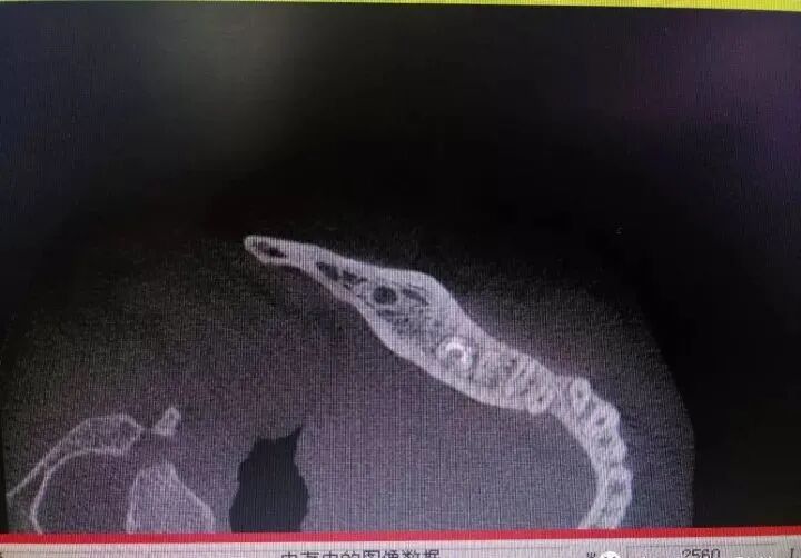 牛牙症的根管治疗步骤及案例