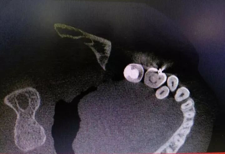 牛牙症的根管治疗步骤及案例