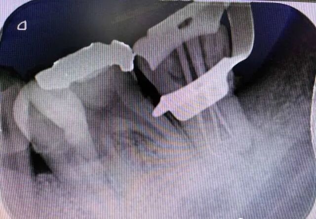 牛牙症的根管治疗步骤及案例