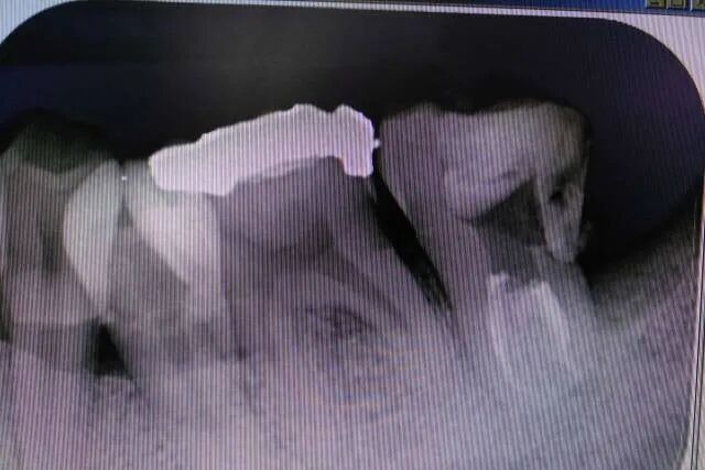 牛牙症的根管治疗步骤及案例