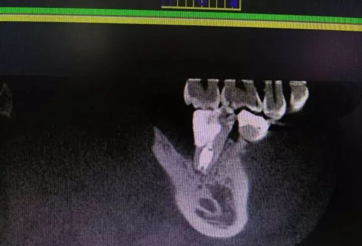 牛牙症的根管治疗步骤及案例