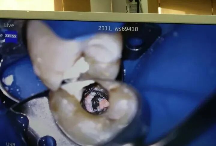 牛牙症的根管治疗步骤及案例