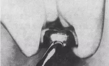 儿童乳牙预成冠详细讲解