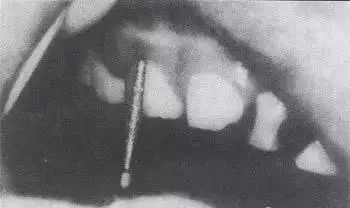 儿童乳牙预成冠详细讲解