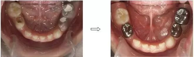 儿童乳牙预成冠详细讲解