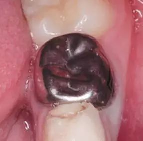 儿童乳牙预成冠详细讲解