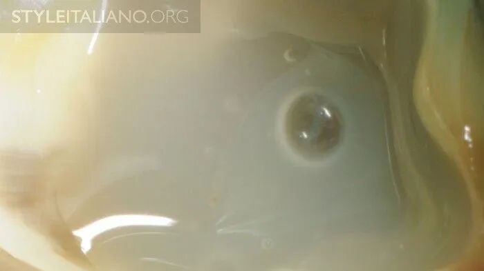 髓腔封闭时减少气泡的方法