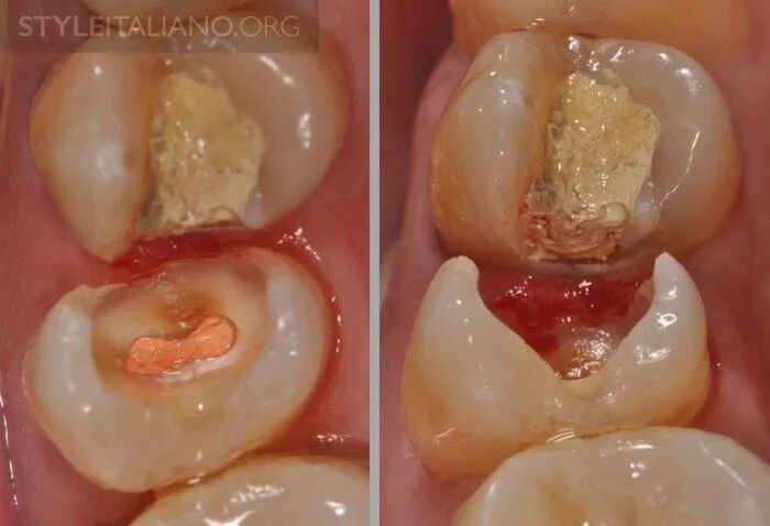 髓腔封闭时减少气泡的方法